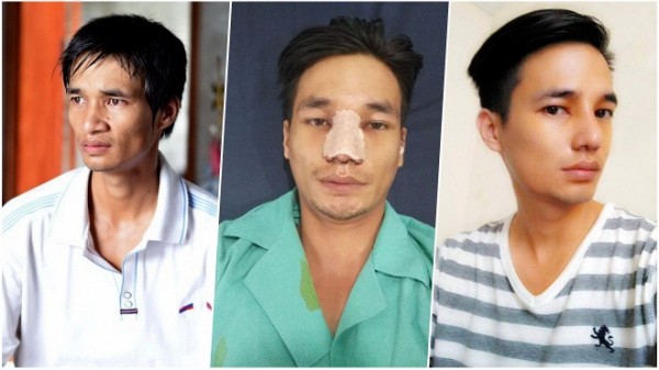 Đời sống - Phẫu thuật thẩm mỹ không phải là đặc quyền của nữ giới (Hình 2).