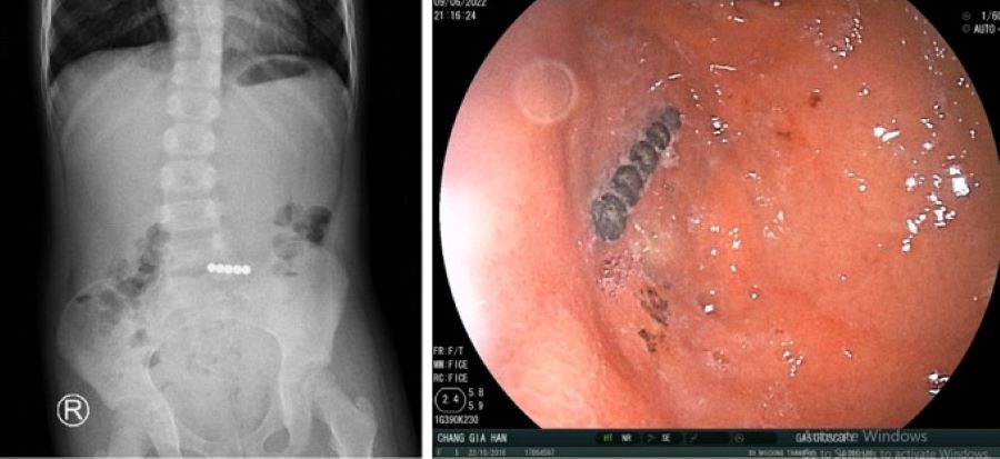Đời sống - Hoảng hồn phát hiện 5 viên bi nam châm dính nhau trong ruột bé gái
