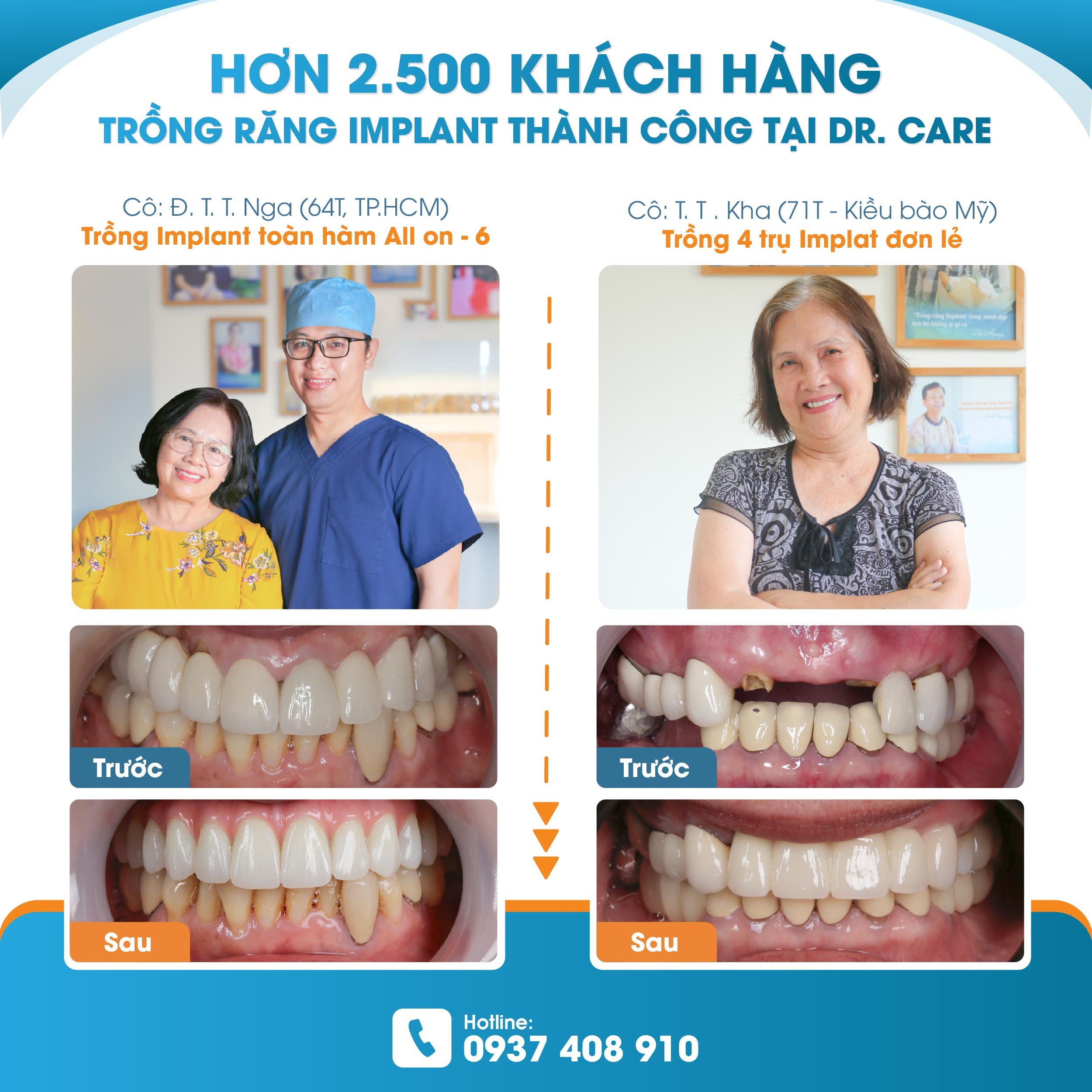 Cần biết - Dr. Care Implant Clinic - Địa chỉ trồng răng Implant uy tín tại TP.HCM (Hình 3).