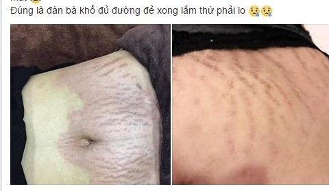 Sức khỏe - Bật khóc khi nhìn bụng rạn sau sinh và bí quyết “vàng” từ bác sĩ sản khoa