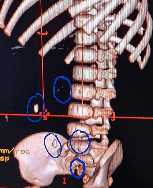 Đời sống - Phát hiện 7 mảnh dao lam trong bụng bé gái 15 tháng tuổi