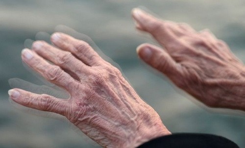 Đời sống - Thấy những dấu hiệu bất thường này, bạn có thể đã bị Parkinson 