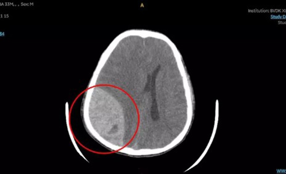 Đời sống - Nam thanh niên bị xuất huyết não nguy kịch sau khi đi bơi (Hình 2).