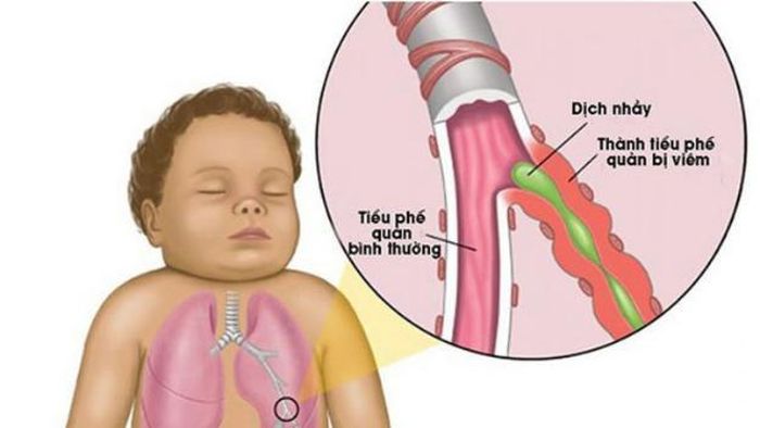 Đời sống - Viêm tiểu phế quản cấp ở trẻ, điều trị như thế nào?