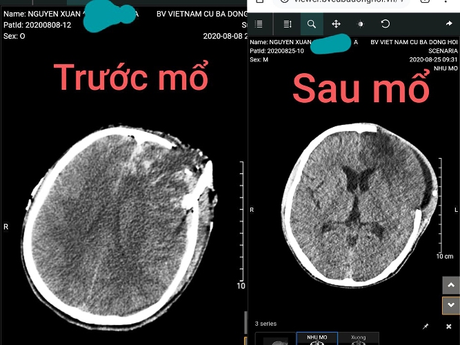 Sức khỏe - Ly kỳ ca cứu chữa thành công nạn nhân bị tai nạn xe máy, não lồi ra ngoài hộp sọ  (Hình 2).