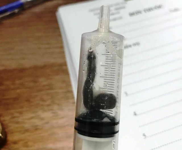 Sức khỏe - Phát hiện con vắt dài 5cm sống trong mũi người phụ nữ trong những ngày Tết