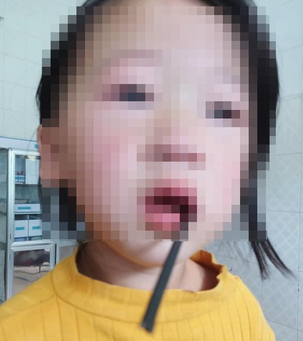 Sức khỏe - Bé gái 4 tuổi bị thanh thép dài 20cm đâm xuyên miệng trong lúc vui đùa