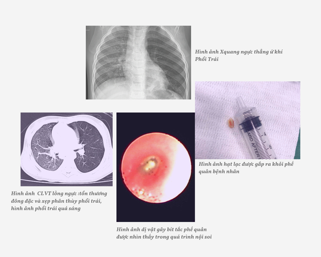 Sức khỏe - Nghệ An: Cứu sống trẻ 18 tháng tuổi ăn hạt lạc bị mắc trong khí quản