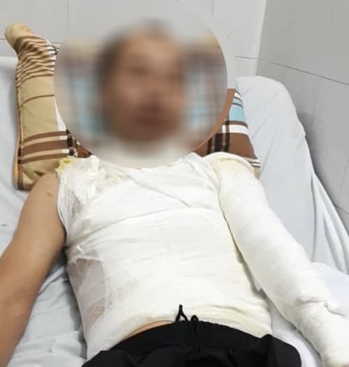 An ninh - Hình sự - Hà Nội: Điều tra, truy bắt đối tượng tạt axit vào mặt một người đàn ông