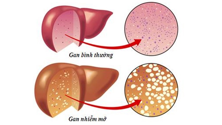 Các bệnh - Những điều cần biết về bệnh gan nhiễm mỡ