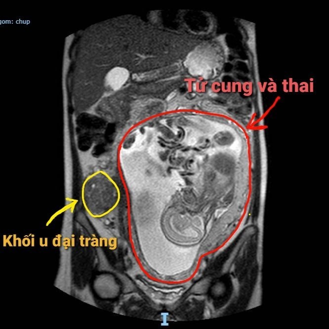 Sức khỏe - Đà Nẵng: Phẫu thuật nội soi ung thư ở thai phụ hiếm gặp trên thế giới