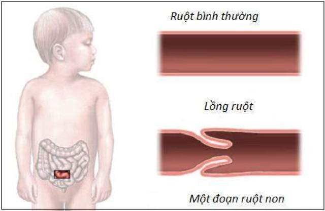 Sức khỏe - Lồng ruột ở trẻ nhỏ dưới 1 tuổi, các bậc phụ huynh hết sức lưu ý