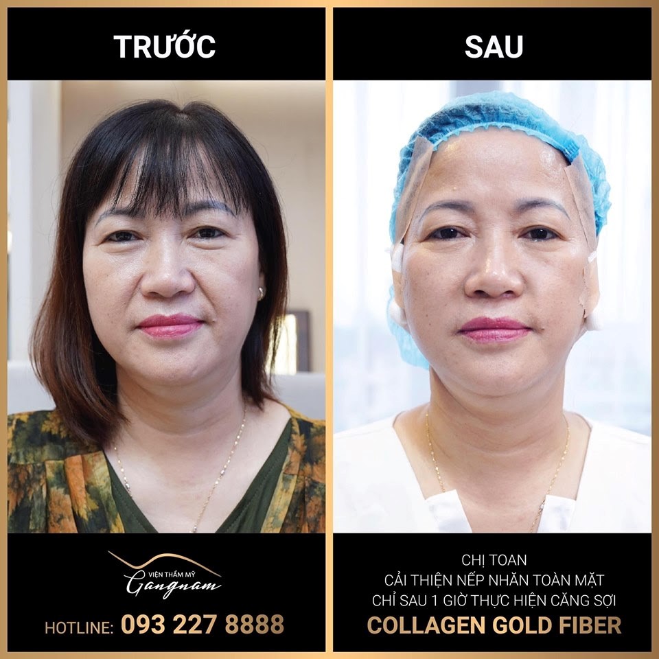 Truyền thông - Những hiệu quả không ai ngờ sau khi căng da bằng chỉ COLLAGEN-VÀNG   (Hình 2).