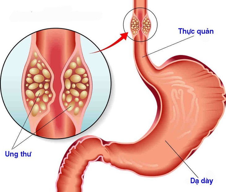 Sức khỏe - Chuyên gia chỉ ra những nhóm người có nguy cơ mắc ung thư thực quản cao