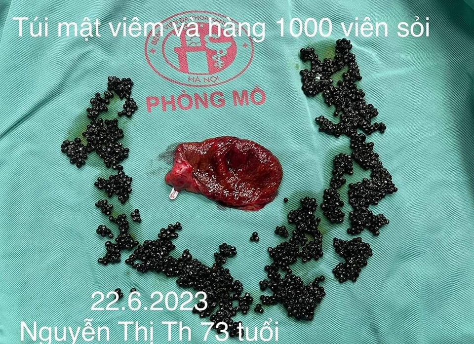 Sức khỏe - Cụ bà 73 tuổi có hàng nghìn viên sỏi trong túi mật