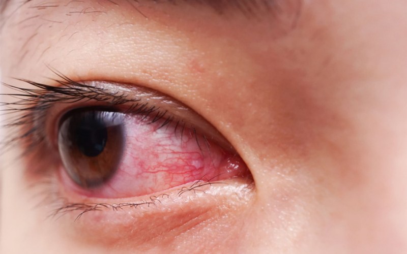Đời sống - Giải đáp câu hỏi: Nhìn nhau có lây bệnh đau mắt đỏ không?