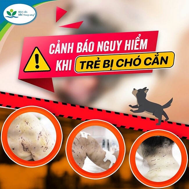 Đời sống - Theo bố tới chỗ làm việc, bé gái 7 tuổi bị 4 con chó cắn hàng trăm vết 