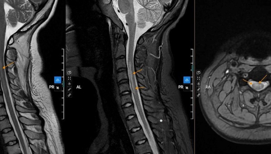 Xã hội - Bản tin 25/4: Thường xuyên tắm muộn, nữ sinh 20 tuổi bị liệt tay