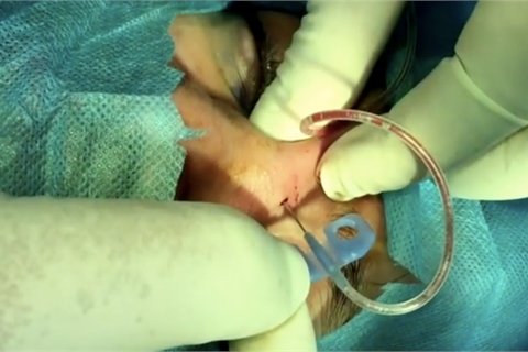 Sức khỏe -  Hotgirl sưng nề mặt 2 năm v&igrave; cục gạc 'mắc kẹt' trong mũi  (H&igrave;nh 2).