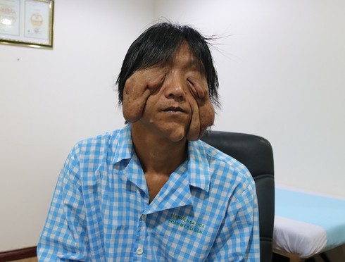 Sức khỏe - Phẫu thuật thành công cho chàng trai mang hình mặt quỷ
