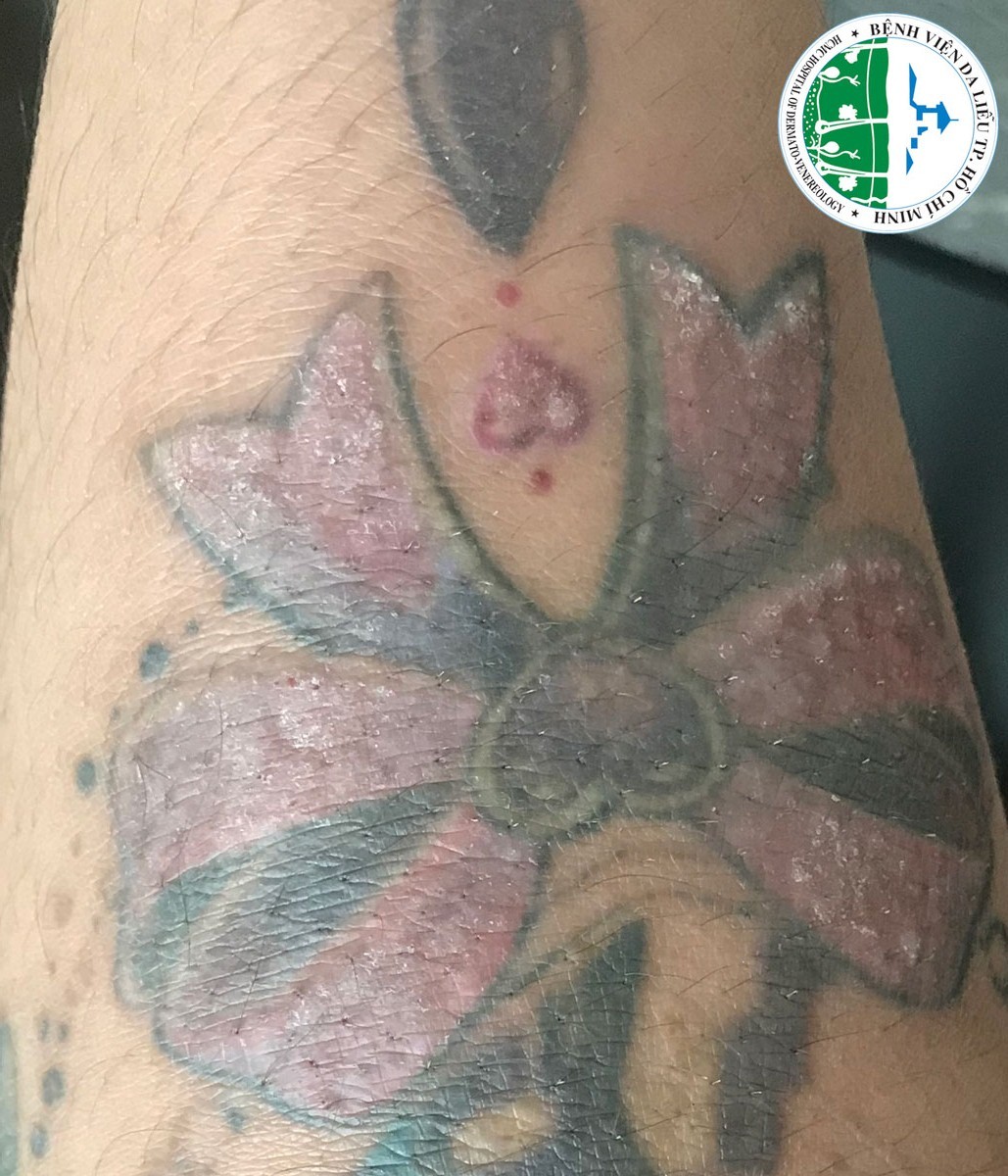 Sức khỏe - Cảnh b&aacute;o nhiều bệnh nh&acirc;n bị nhiễm tr&ugrave;ng nặng do xăm h&igrave;nh