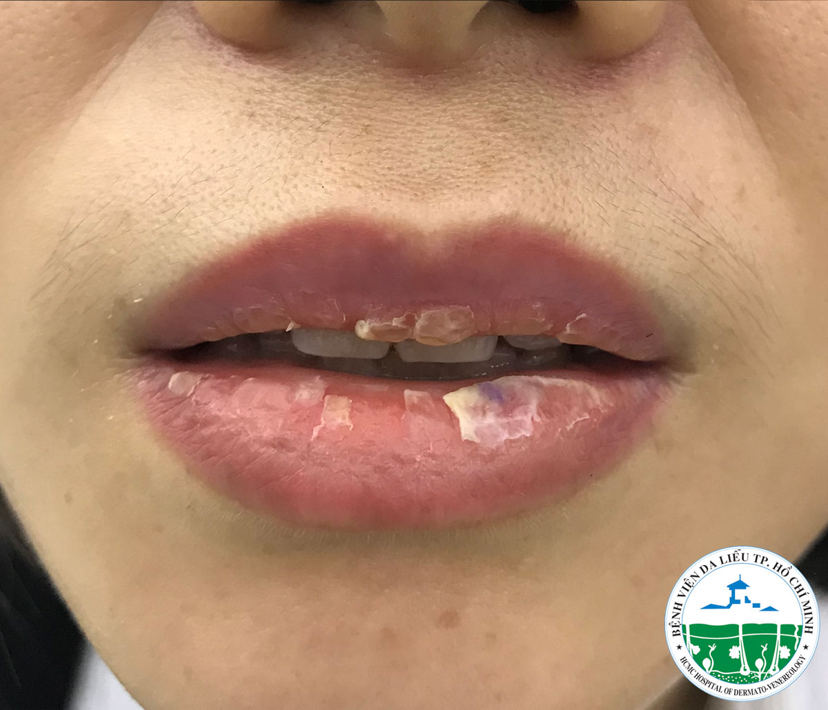 Sức khỏe - Cảnh b&aacute;o nhiều bệnh nh&acirc;n bị nhiễm tr&ugrave;ng nặng do xăm h&igrave;nh (H&igrave;nh 2).