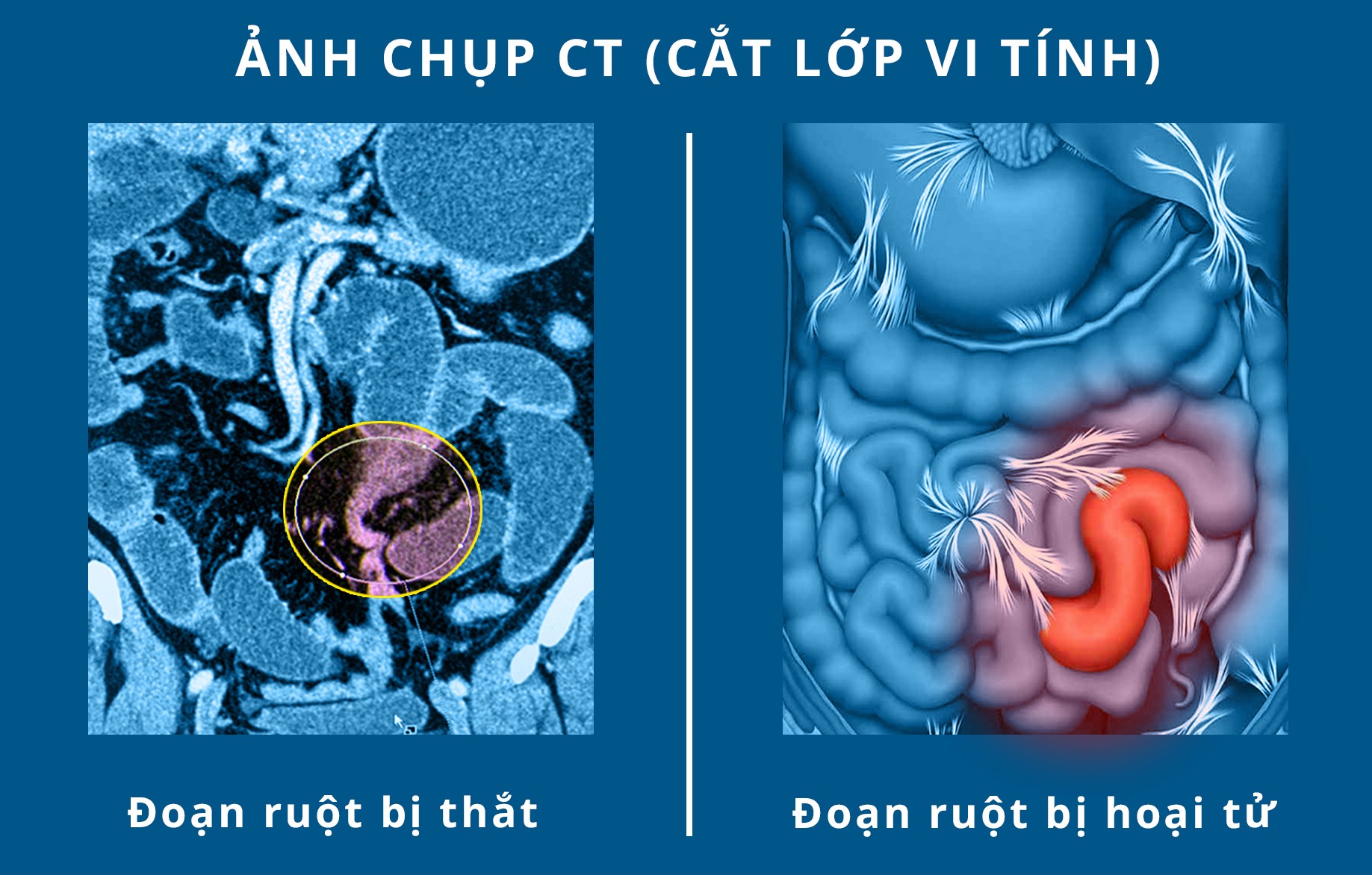 Sức khỏe - Người đàn ông suýt tử vong vì hoại tử ruột được cứu sống kịp thời (Hình 2).