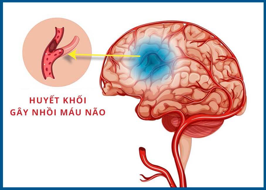 Sức khỏe - Người phụ nữ đột quỵ khi đang phơi quần áo được cứu sống kịp thời