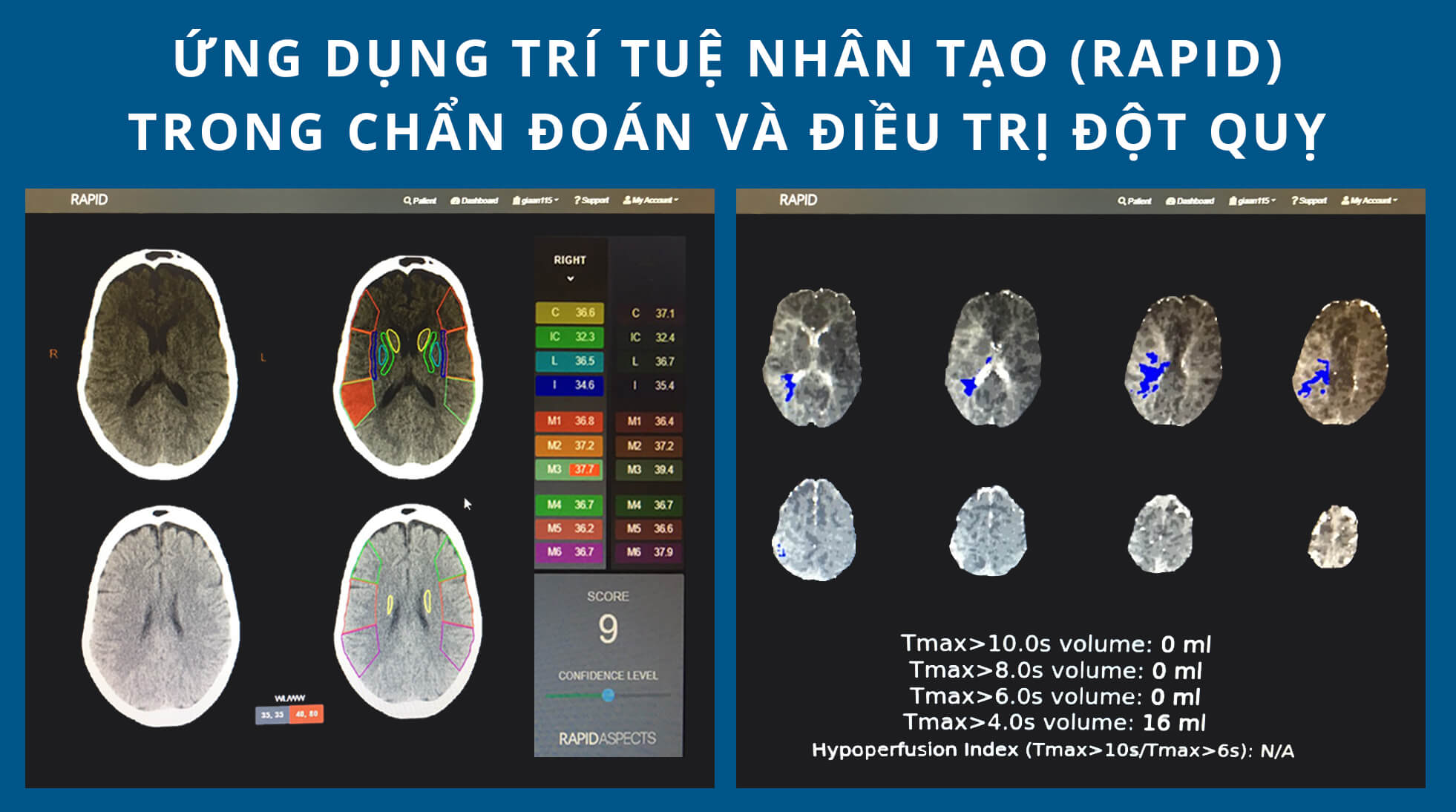 Sức khỏe - Người phụ nữ đột quỵ khi đang phơi quần áo được cứu sống kịp thời (Hình 2).