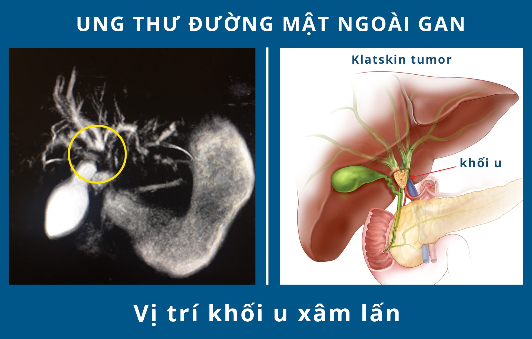 Sức khỏe - Cứu sống cụ bà bị ung thư đường mật ngoài gan nguy hiểm (Hình 2).