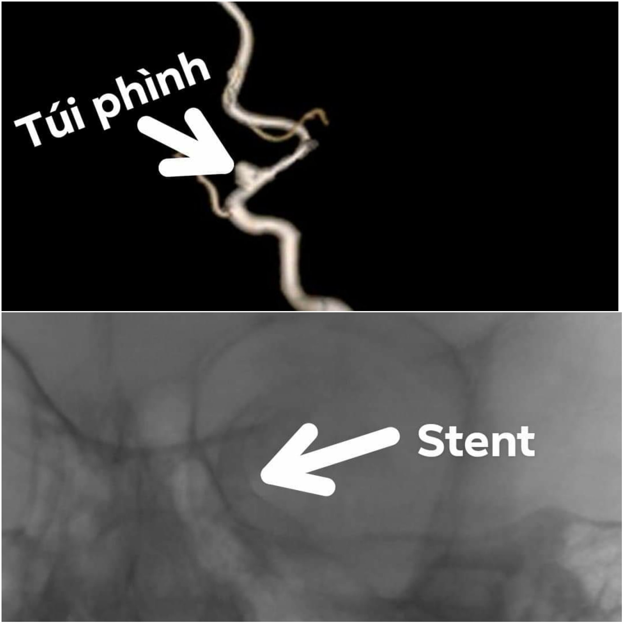 Tin nhanh - Bé trai 3  tuổi đang chơi với bạn bỗng dưng đột quỵ (Hình 2).