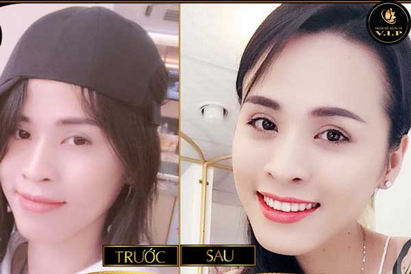 Sức khỏe - Những ca phẫu thuật “vịt hóa thiên nga” tại V.I.P (Hình 7).