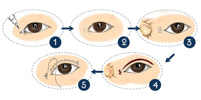 Mở rộng góc mắt chuẩn y khoa tại V.I.P (Hình 2).