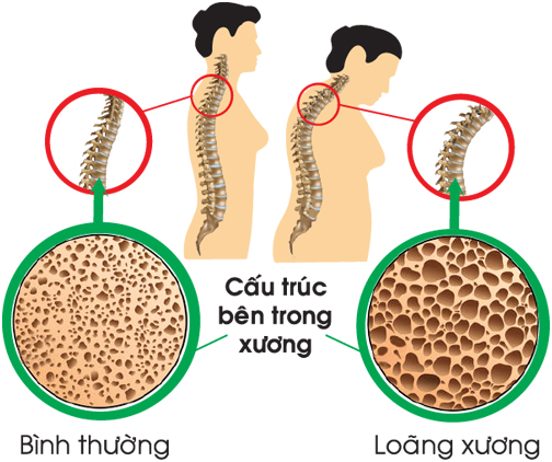 Loãng xương, căn bệnh thầm lặng nguy hiểm dễ bị lãng quên