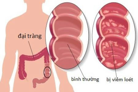 Chữa bệnh viêm đại tràng – Khó mà dễ