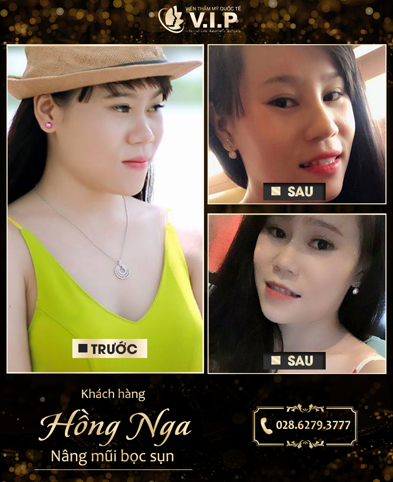 Ngẩn ngơ trước vẻ đẹp của những cô nàng sau nâng mũi bọc sụn (Hình 5).