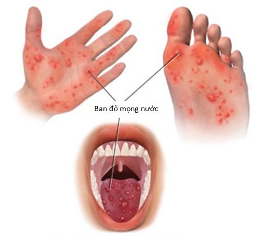 Cần biết - Top bệnh nguy hiểm “bám riết” trẻ nhỏ vào mùa hè (Hình 3).