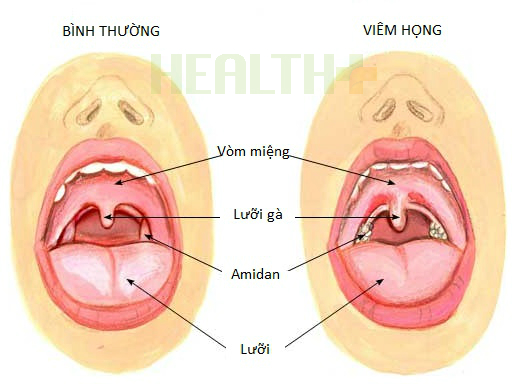 Thương hiệu - Trẻ bị viêm họng phải làm sao? (Hình 2).