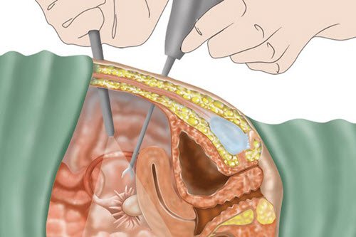 Sức khỏe - Thảo dược Nga Phụ Khang giúp hỗ trợ chữa u nang buồng trứng không cần mổ