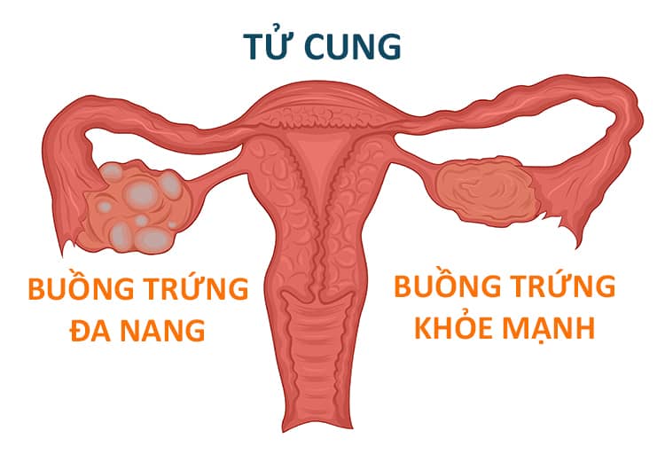 Sức khỏe - Buồng trứng đa nang và phương pháp giúp có con tự nhiên bạn cần biết