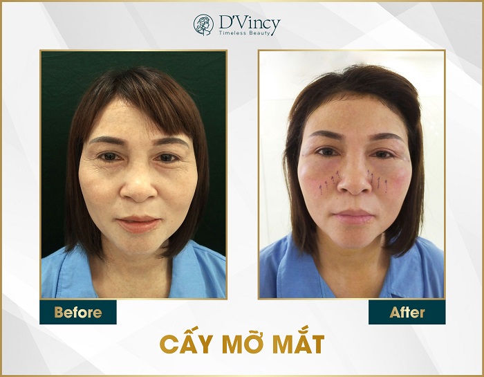 Truyền thông - Cấy mỡ tự thân có thể cấy được vào những vùng nào trên cơ thể? (Hình 3).