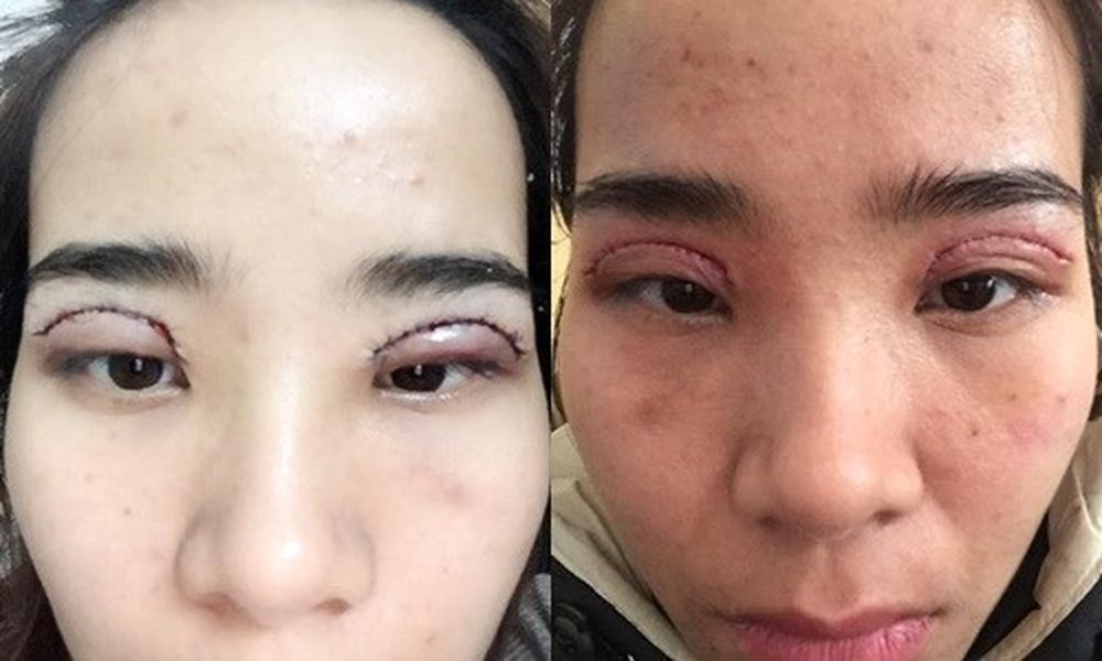 Truyền thông - Những biến chứng có thể xảy ra sau cắt mí và cách khắc phục (Hình 2).