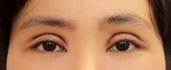 Truyền thông - Những biến chứng có thể xảy ra sau cắt mí và cách khắc phục (Hình 3).