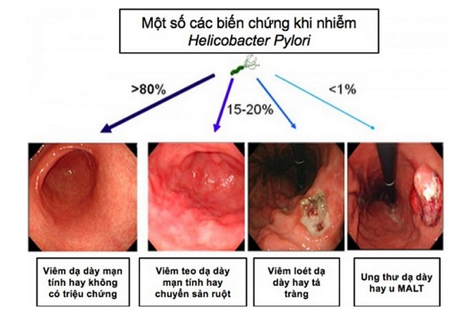 Thương hiệu - Tiêu diệt vi khuẩn HP nguyên nhân gây ung thư dạ dày