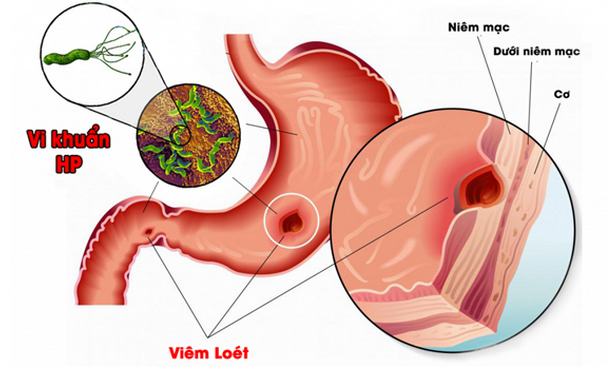 Thương hiệu - Tiêu diệt vi khuẩn HP nguyên nhân gây ung thư dạ dày (Hình 2).