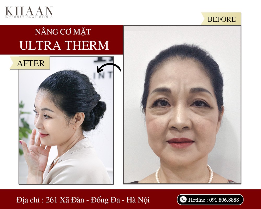 Thương hiệu - Ultra Therm – Công nghệ trẻ hóa làn da, kéo dài thanh xuân 