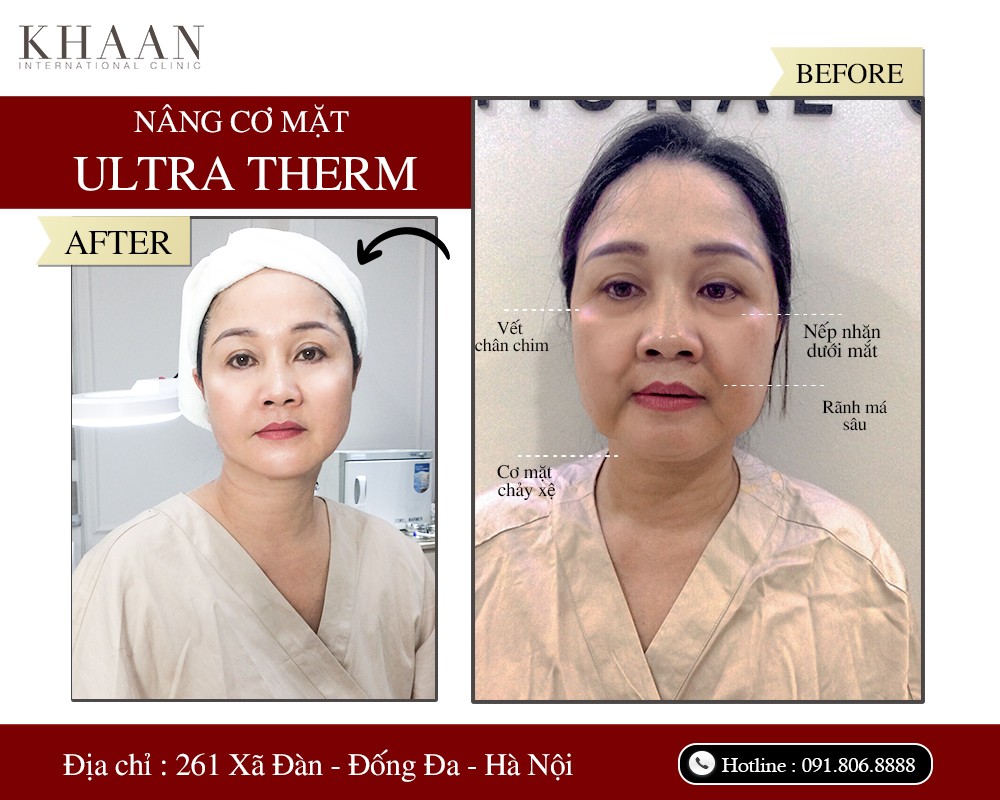 Thương hiệu - Ultra Therm – Công nghệ trẻ hóa làn da, kéo dài thanh xuân  (Hình 3).