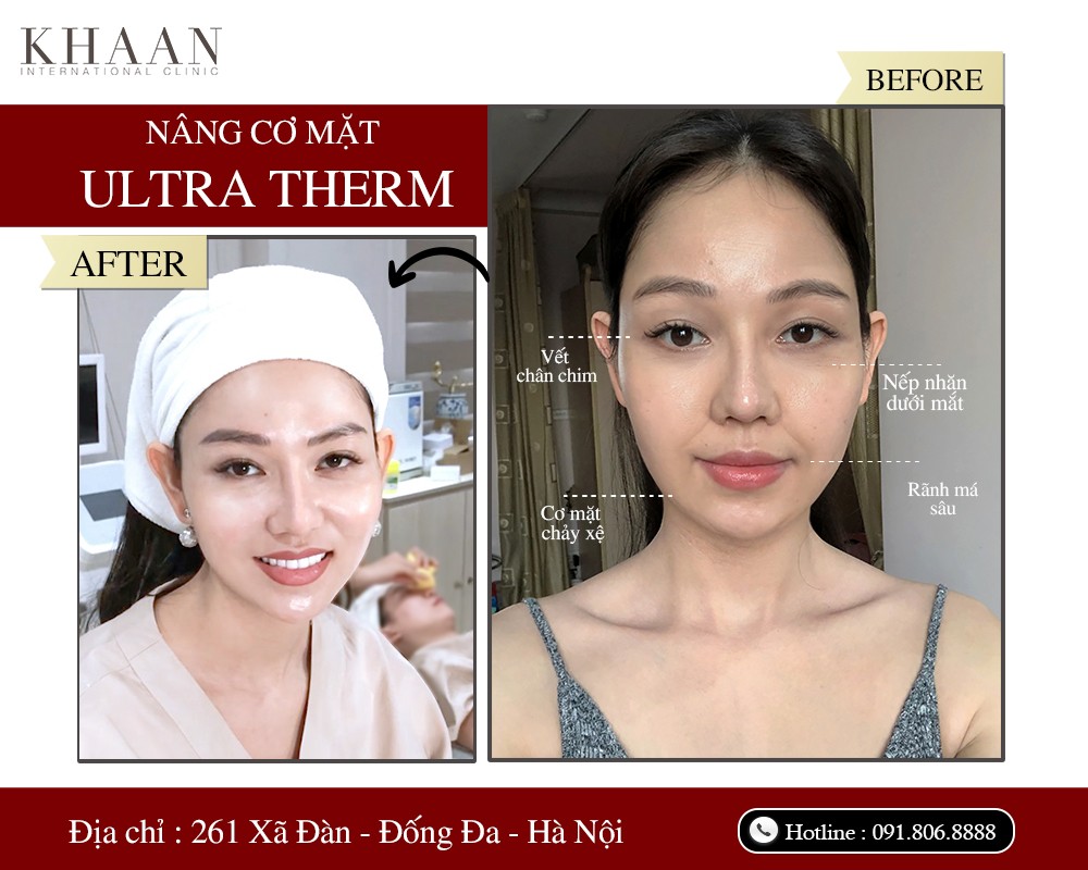 Thương hiệu - Ultra Therm – Công nghệ trẻ hóa làn da, kéo dài thanh xuân  (Hình 4).