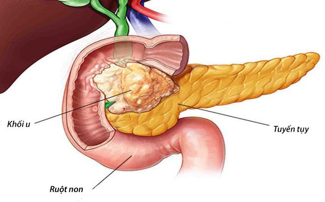 Truyền thông - Giải mã các bí mật mà bệnh nhân ung thư tụy giai đoạn cuối nào cũng cần biết