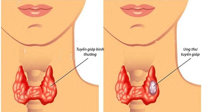 Truyền thông - Thấy các dấu hiệu này của bệnh ung thư tuyến giáp bạn cần đi gặp bác sỹ ngay 